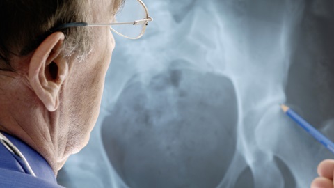 osteoporosis